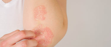 Psoriasis-Pflege kortisonfrei: Was geht, was nicht — und wann der Arzt dran ist