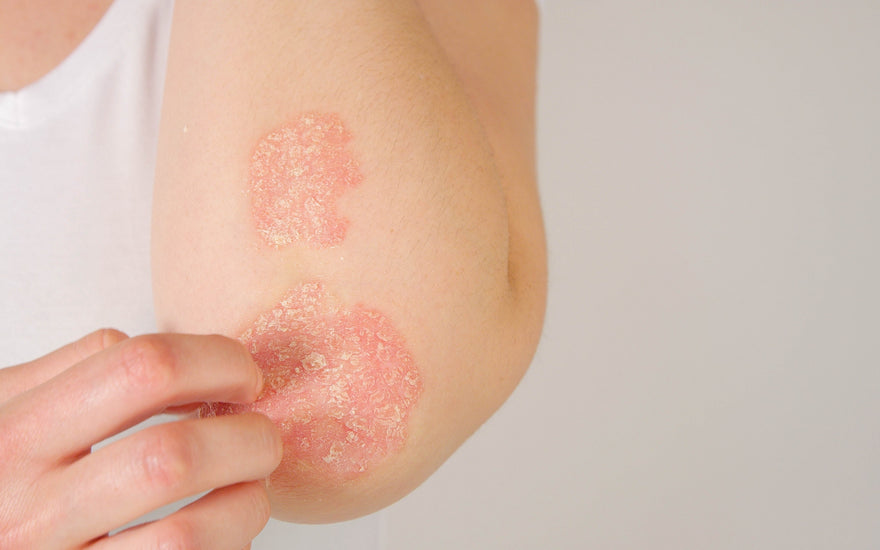 Psoriasis-Pflege kortisonfrei: Was geht, was nicht — und wann der Arzt dran ist