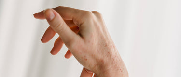 Gereizte, gerötete Hände – Hand- und Fußekzem