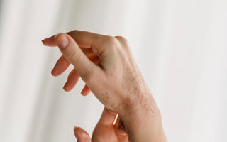 Gereizte, gerötete Hände – Hand- und Fußekzem